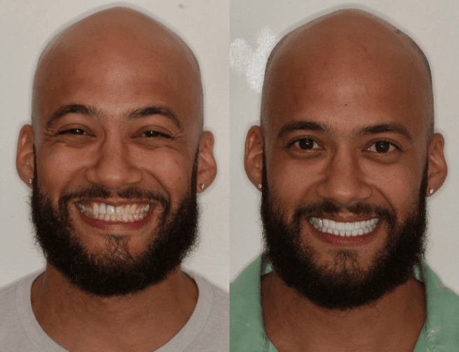 Antes — Reabilitação protética