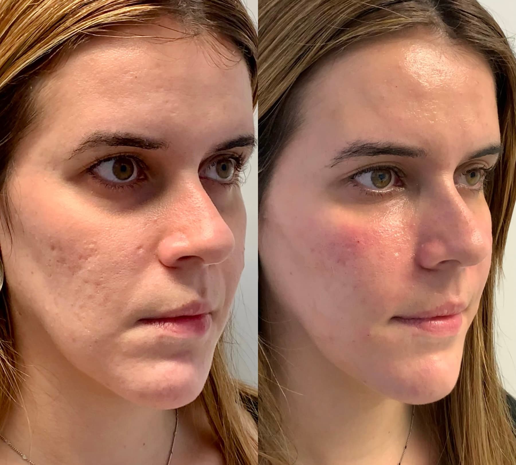 Antes e depois — Bioestimulador de colágeno