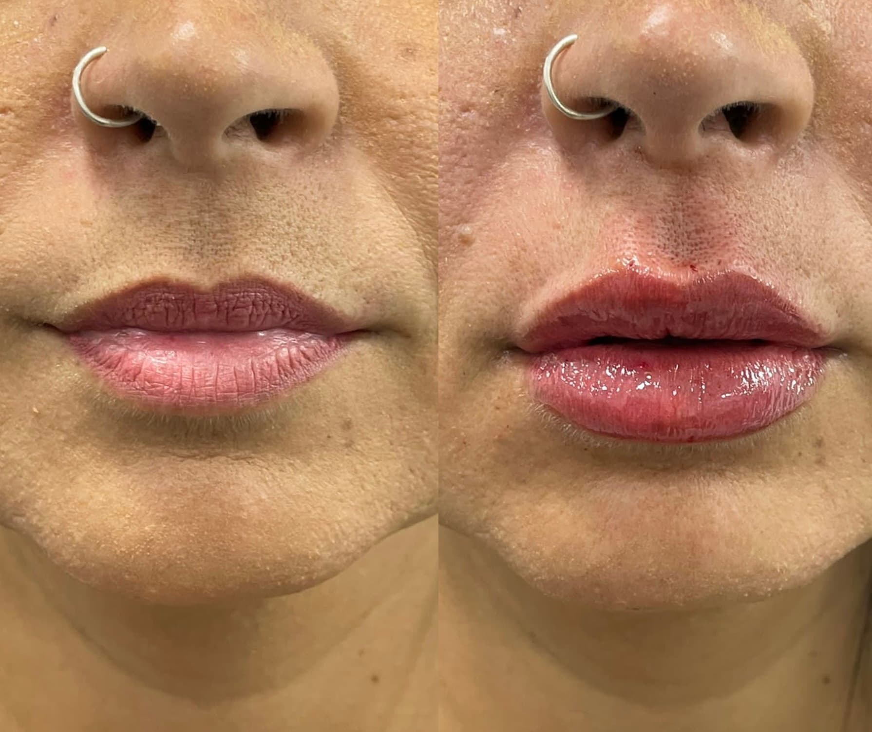 Antes e depois — Preenchimento labial